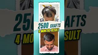 2500 Grafts Hair Transplant  4 Months Result hairtransplant hair shorts ytshorts [upl. by Hoashis114]