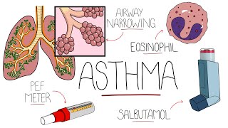 Asthma Explained Including Pathophysiology [upl. by Earleen101]