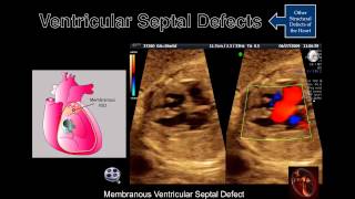 Fetal Echocardiography Ventricular Septal Defects [upl. by Anuqahs729]