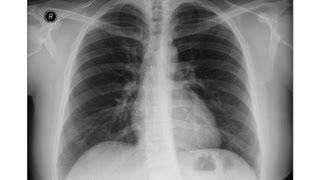 Chest xray  Asbestosis  Pleural calcifications  Round atelectasis [upl. by Anirtep]