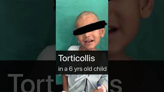 Torticollis surgery [upl. by Apur479]