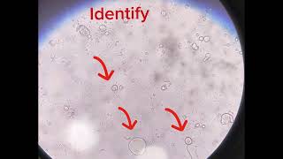 Fat Droplets Stool Routine Examination [upl. by Eveiveneg]