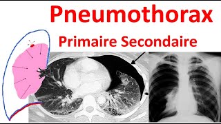 Pneumothorax spontané primitif secondaire Radiologie douleur thoracique traitement Anatomie plèvre [upl. by Dusza505]