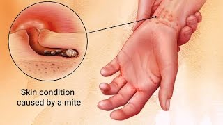 Causes Symptoms and Treatment of Scabies [upl. by Ramma]