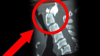 SURVIVING AN ODONTOID PROCESS C2 FRACTURE  quotThe Amazing Recoveryquot [upl. by Monetta728]