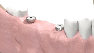 SIC invent Dental Implant  Prosthetic Animation BridgeWork Open Tray Technique [upl. by Emerson]