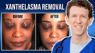 Removing Xanthelasma with Lasers  Thirzas Testimonial [upl. by Lidah]