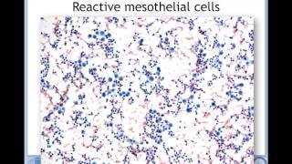 Prof JFのレクチャー Pathology of mesothelial cells [upl. by Quartas]