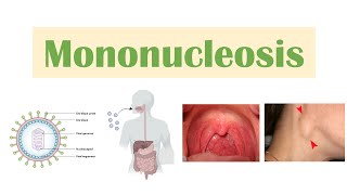 Infectious Mononucleosis Mono  EpsteinBarr Virus Transmission Symptoms Diagnosis Treatment [upl. by Oiram]