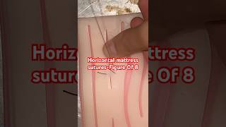 Horizontal mattress sutureFigure Of 8 surgeon stitch [upl. by Akirdnahs]