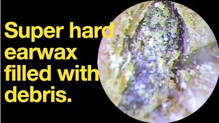 Super hard earwax filled with debris ear wax removal  ear cleaning  ASMR  relaxation  relax [upl. by Haroppizt]