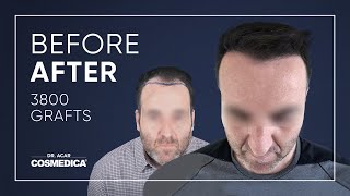 Transformation after Hair Transplant Surgery [upl. by Ttocserp]