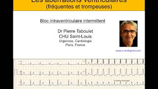 4h Aberration ventriculaire bloc de branche ou ESV  ECG Dr Taboulet [upl. by Aztiram]