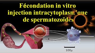 infertilité stérilité Insémination artificiel intra uterine FIV ICSI [upl. by Drhacir627]