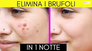 Acne rimedi naturali per benefici immediati [upl. by Ardnnaed]