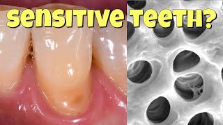 Why teeth get sensitive and how to fix it [upl. by Stern458]