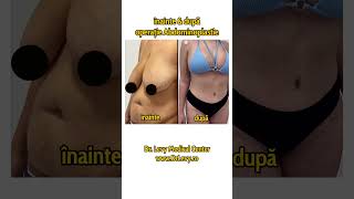 Înainte și după operație de Abdominoplastie  exces de piele abdomen  La Doctor Levy România [upl. by Lexerd230]