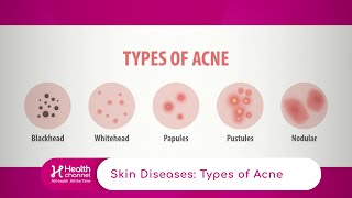 Types of Acne [upl. by Sacha]