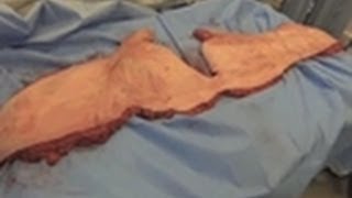 Patient Sees Removed Skin  The Real Skinny [upl. by Navinod]