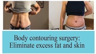 Body Contouring Surgery To Eliminate Excess Skin amp Fat  The Esthetic Clinics India [upl. by Seni]