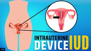 Intrauterine Device IUD Everything You Need To Know [upl. by Nahtnahoj]