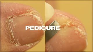 Satisfying PEDICURE TRANSFORMATION at home  Cuticle amp Callus Removal [upl. by Aible]