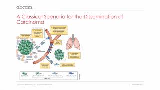 Cancer Epithelial mesenchymal transition in carcinoma 211 [upl. by Eicram516]