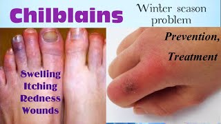 Chilblains  chilblains treatment [upl. by Nilyram]