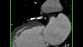 Cardiac extensive calcifications in the LAD 3 of 4 [upl. by Karlyn]