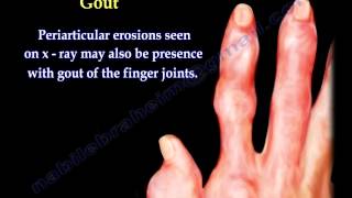 Arthritis Of The Fingers types and patterns  Everything You Need To Know  Dr Nabil Ebraheim [upl. by Leola]