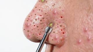 ACNE REMOVAL  Pimple Popping  SATISFYING Blackhead amp Whitehead Extraction [upl. by Arun187]