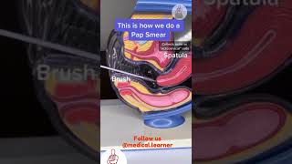 How to do pap smear  pap smear procedure  gynecology pap smear  medical learner  steps to do pap [upl. by Neely]