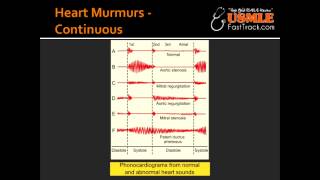 Heart Murmurs  Patent Ductus Arteriosus PDA [upl. by Jasmine659]