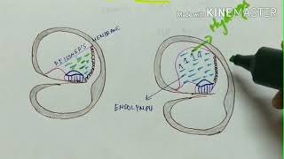 menieres disease  ENT  inner ear disease  etiology  clinical features  diagnosis  treatment [upl. by Liemaj777]