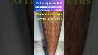 Varicose veins treatment  Result after 3 months Best varicose veins treatment for SSC GD medical [upl. by Townshend]