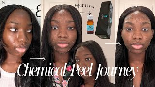 CHEMICAL PEEL  The perfect derma peel Hyperpigmentation Texture Before amp After on DARK SKIN [upl. by Halika903]