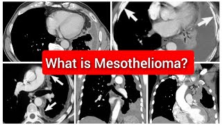 Mesothelioma of Pleura CT Chest [upl. by Zeugirdor]