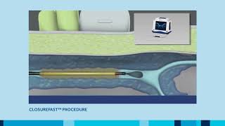 ClosureFast Procedure for Varicose Vein treatment [upl. by Baiel]