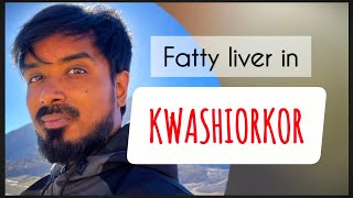 Why fatty liver in kwashiorkor proteincalorie malnutrition [upl. by Hcab118]