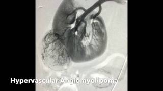 Renal Angiomyolipoma AML Transcatheter Ethanol Alcohol Embolization [upl. by Cornwall]