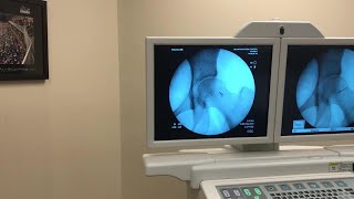 IntraArticular Injection of the Hip Under Fluoroscopic Guidance [upl. by Rechaba]