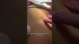 DPNs Dermatosis Papulosa Nigra spots removal skincare dermatology [upl. by Airamzul]