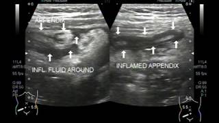 Ultrasound Video showing acute appendicitis with prominent mesenteric lymph nodes [upl. by Tace697]