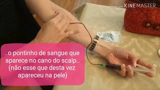 Passos  Auto Hemoterapia em si mesmo sozinho [upl. by Hcirdeirf]