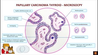 Papillary Thyroid Carcinoma  Histopathology [upl. by Schnell182]