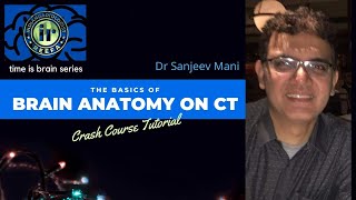 TIME IS BRAIN SERIES  CT BRAIN  ANATOMY TUTORIAL  DR SANJEEV MANI  NEUROPARENCHYMA amp VENTRICLES [upl. by Howie]