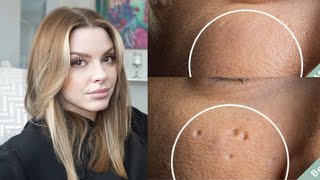 Esthetician Discusses How To Eliminate Pitted Acne Scars [upl. by Munmro]