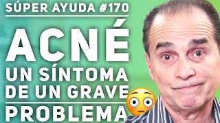 SÚPER AYUDA 170 Acné Un Síntoma De Un Grave Problema [upl. by Jaeger114]