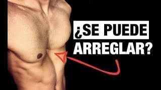 ¡Cómo Arreglar EL PECHO HUNDIDO PECTUS EXCAVATUM [upl. by Collete31]