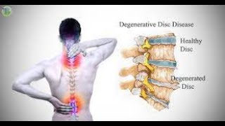 Neck pain slipped disc in the neck English version [upl. by Ahsenra646]